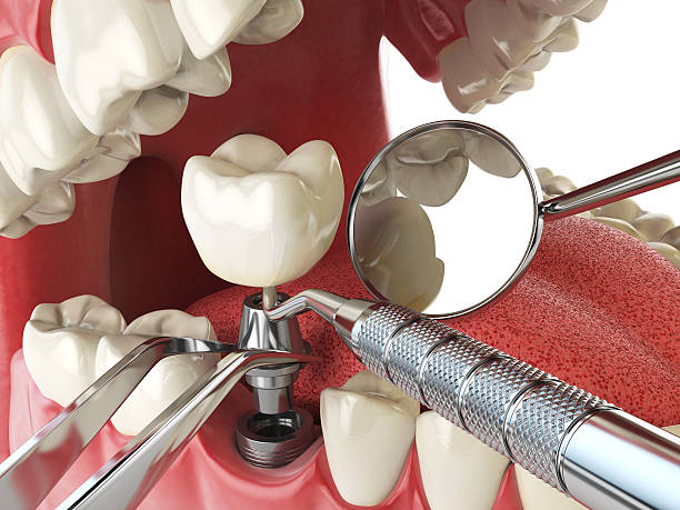 Best Emergency Tooth Extraction in Wheatland, WY